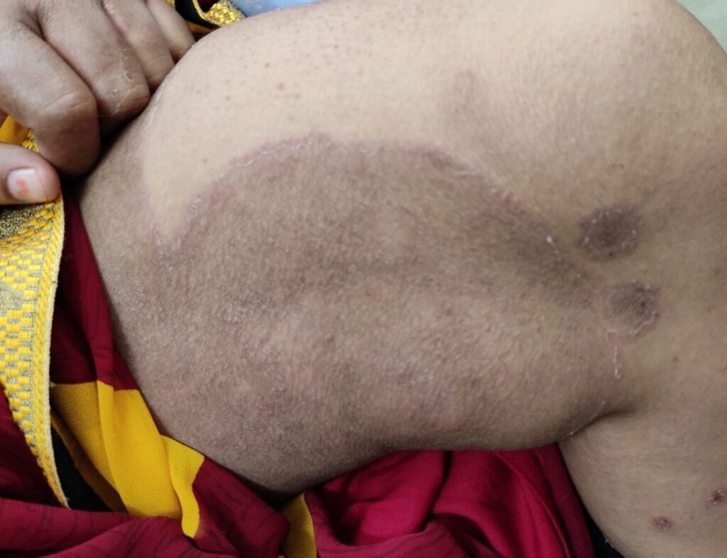 Tinea cruris, Jock itch